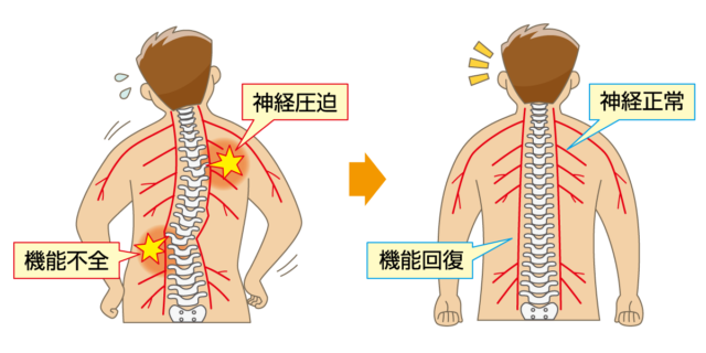 脊柱の歪みは、そこから出る神経を圧迫し、神経の機能不全を引き起こします。